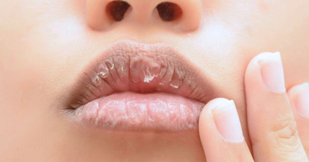 ¿Qué enfermedades resecan los labios?